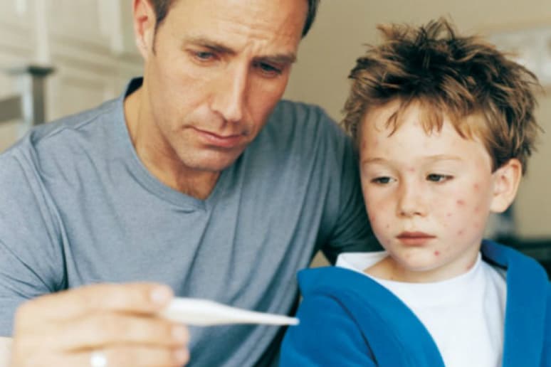 Have Chicken Pox? Foods to Eat and Avoid